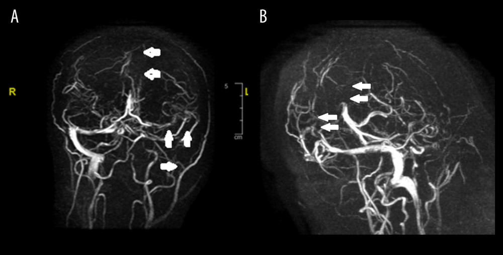 (A) MR venogram in coronal section shows absence of opacification (white arrows) of superior sagittal sinus, inferior sagittal sinus, transverse sinus, sigmoid sinus, straight sinus, and great cerebral vein. (B) MR venogram in sagittal section showing absence of opacification (white solid arrows) of the same sinuses.