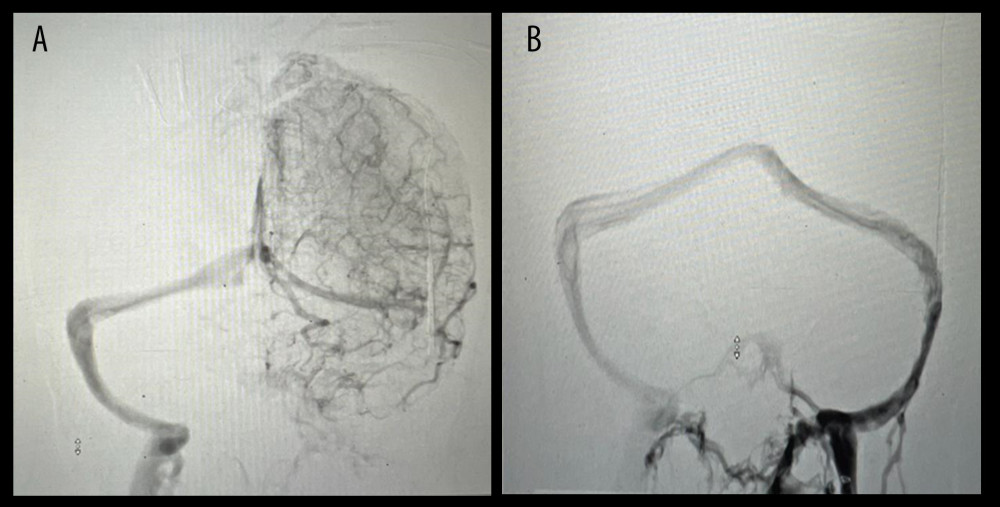(A) Antero-posterior caudally (AP Caudal) tilted fluoroscopic view before endovascular thrombectomy shows contrast filling right internal jugular vein with no flow in the superior sagittal sinus, left sigmoid sinus, and left internal jugular vein (background cerebral blush suggesting increased venous pressure). (B) AP caudal fluoroscopic view after thrombectomy shows restored flow in the left transverse and left sigmoid sinuses, along with left internal jugular vein.
