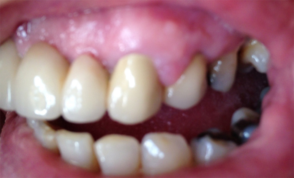 A 66-year-old female patient with gingival hyperplasia due to cyclosporine A medication as part of a multi-drug regimen for membranous nephropathy.