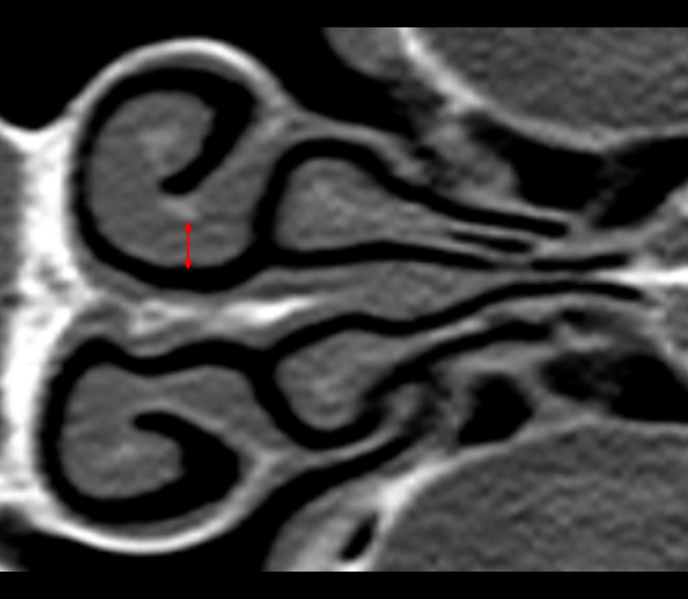 CT scan showing regression of hyperplasia 6 months after discontinuation of cyclosporin A. The diameter at a corresponding anatomical location as compared to the baseline scan was 2.8 mm.