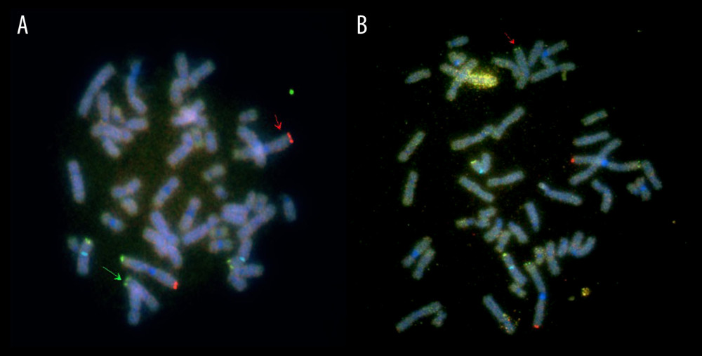 (A) The index case’s FISH karyotype: The green arrow denotes chromosome 1’s short arm’s terminal region translocated on to chromosome 6’s long arm. The red arrow indicates derivative chromosome 1. (B) IV-5’s FISH karyotype: The red arrow shows derivative chromosome 6 with chromosome 1’s short arm’s terminal region translocated on to it. Reagents used: 1pter CEB108/T7 (green)/1qter VIJyRM2123, 1QTEL10 (D1S3738) (orange)/CEP X (Xp11.1-q11.1) (aqua)/Xpter/Ypter DXYS129, DXYS153 (green+orange). Vysis ToTelVysion (Abbott Molecular, Inc.; USA) subtelomeric FISH probes, LSI p58 (1p36) microdeletion syndrome FISH probe (Abbott Molecular, Inc.) and XL CHD5 (1p36.3)/ABL2 (1q25) (MetaSystems; Germany).