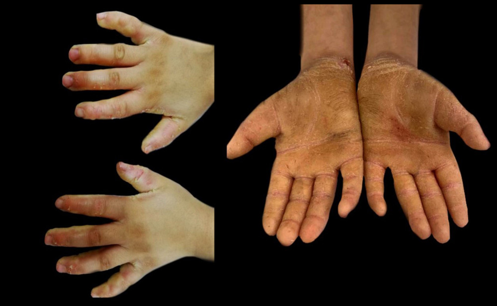 Palmer Keratoderma: diffuse palmer keratoderma extending to the dorsal hands, mild sclerodermatous changed of the dorsal fingers along with pseudoainhum formation over the 5th fingers. Localized area of erosion is noticed over the right wrist.