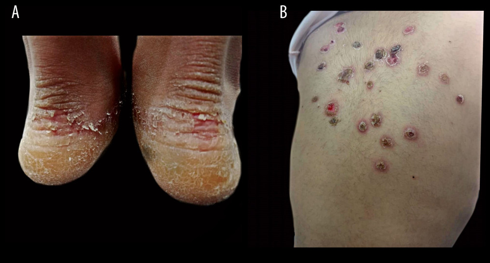 (A) Planter Keratoderma: the diffuse keratoderma is extending to the Achilles’ tendon mimicking the clinical picture of Greither syndrome. (B) Trunk Epidermolytic Plaques: coin-shaped superficial crusted erosions, with several annulare polycyclic scaly plaques over the upper left quadrant of the back.