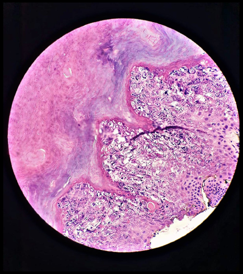 Hematoxylin and Eosin (H&E) staining, 40 high-power field: shows compact hyperkeratosis, granular and vacuolar degeneration of the spinous layer, and large irregular keratohyaline granules.