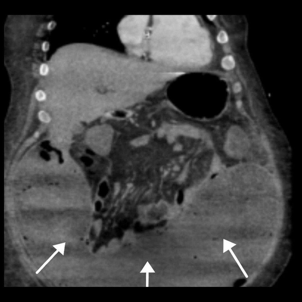 CT scan demonstrating the large, tube-like encapsulated compartmentalized abscess (see arrow indicating abscess).