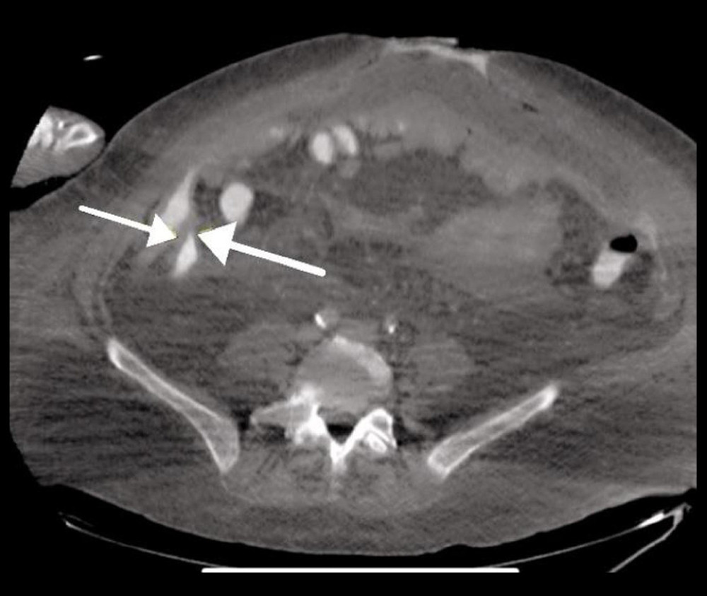 CT scan postoperative day 1 demonstrating the leak of contrast in the right lower abdomen (see arrow indicating contrast leak).