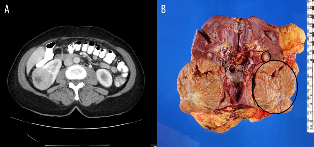 (A) CT imaging shows right renal mass (6.6 cm in diameter). (B) Photograph of the gross surgical specimen of the right kidney (bivalved coronally) shows the presence of 2 renal masses.