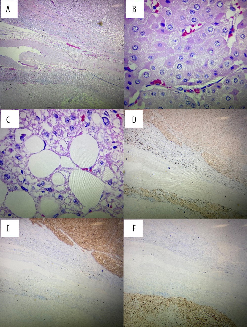 (A) H&E-stained section shows the relationship between the 2 masses. The oncocytoma is present in the upper field separated from AML, which is present in the lower field, showing as a thin area of renal parenchyma (40×). (B) H&E-stained section of the larger tumor shows tumor cells with dense eosinophilic cytoplasm and round regular nuclei (400×). (C) H&E-stained section of the smaller tumor shows admixture of mature adipose tissue formation and aggregate of epithelioid tumor cells (400×). The oncocytoma is positive for PAX-8 (D) and CD117 (E), while the AML is positive for melan-A (F) (40×).