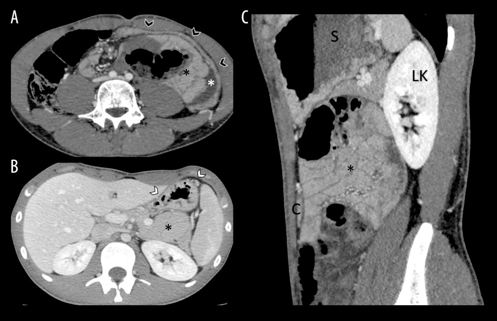 Axial CT contrast-enhanced (A, B) and sagittal CT contrast-enhanced (C) images show the presence of the herniated bowel loops with a sac-like appearance (black asterisk); fluid peritoneal collection can be found nearby (white asterisk). The herniated bowel loops cause partial dislocation of the transverse colon (black arrowheads) and of the stomach (white arrowheads). S – stomach; LK – Left kidney; C – transverse colon.