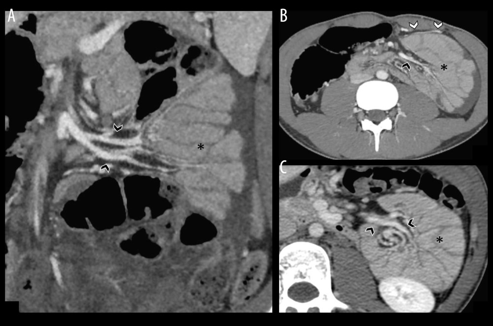 Oblique coronal CT contrast-enhanced (A), axial CT contrast-enhanced (B), and particular of axial CT contrast-enhanced (C) images show the vascular involvement due to the left paraduodenal hernia: mesenteric vessels supplying the herniated loops (black asterisk) are stretched and engorged (black arrowheads), while the inferior mesenteric vein (white arrowheads) is typically found anteriorly to the herniated loops.