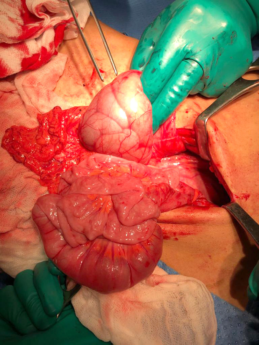 Jejunal loops presenting with a sac-like appearance after median laparotomy.