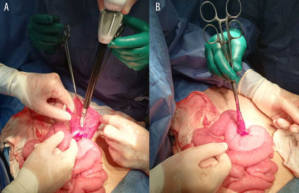 (A) Opening and resection of the herniary bag via Enseal (Ethicon). (B) Binding of the herniary bag containing the loops at the base.