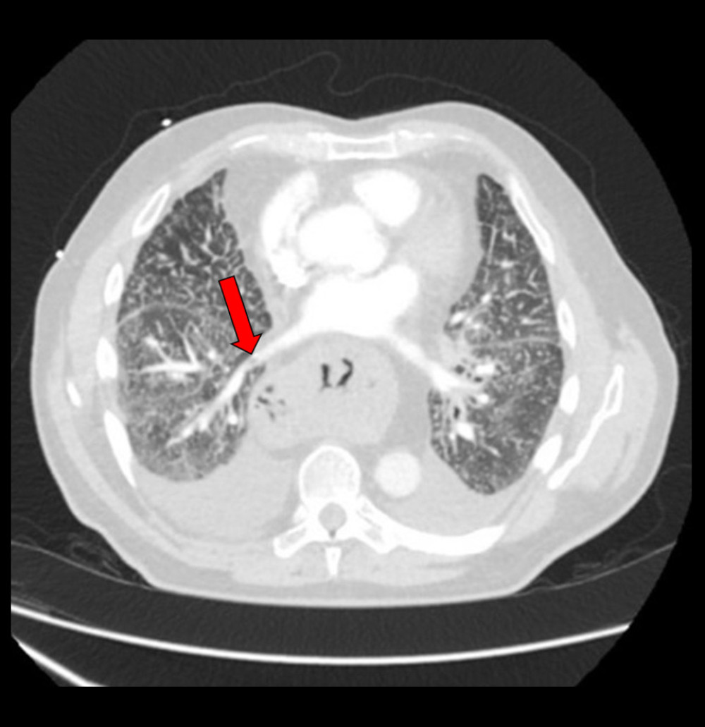 CT angiogram of chest showing right lower lobe segmental branch pulmonary embolism demonstrated by the red arrow, diffuse interlobular septal thickening with associated ground glass, bilateral pleural effusion, and massive hiatal hernia causing compression of the left atrium and pulmonary veins.
