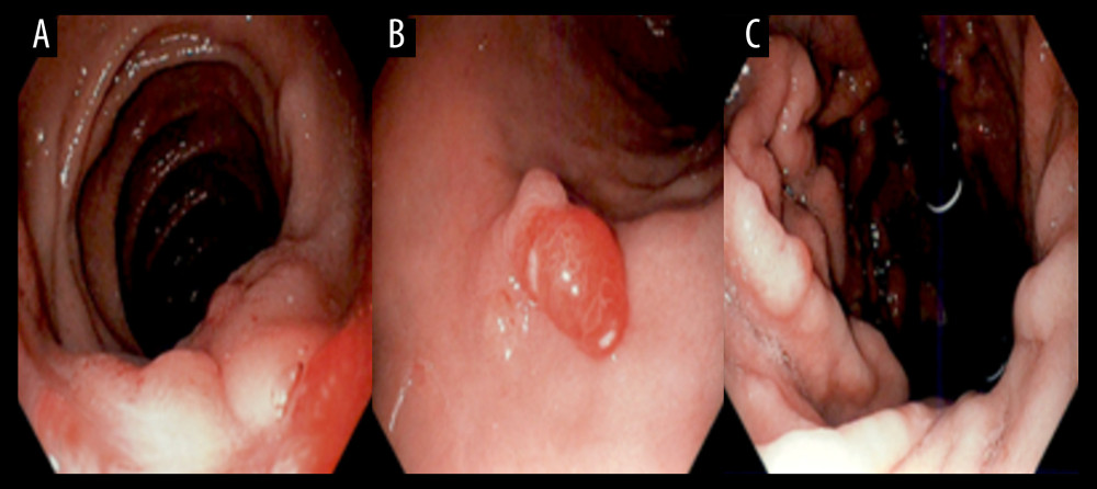 Series of images from esophagogastroduodenoscopy showing in image A. An irregular Z-line and a 4 cm hiatal hernia, in image B. A 2-cm tongue of salmon-colored mucosa in the esophagus, and in image C. Diffusely thickened circumferential edematous nodular gastric folds.