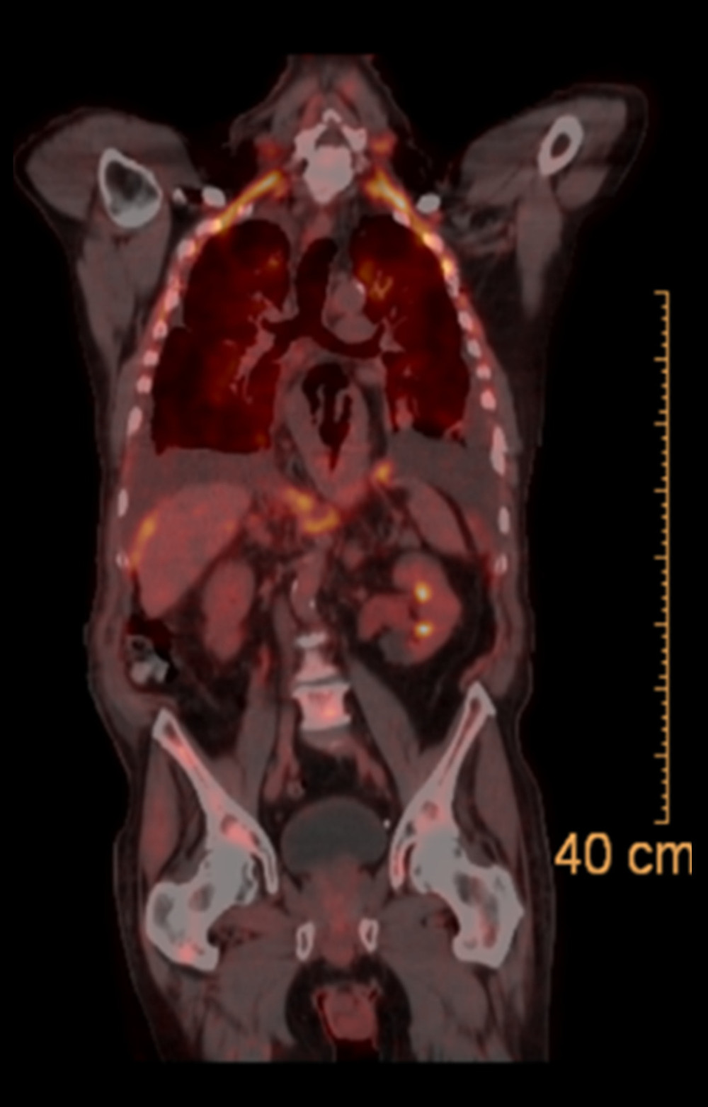 PET/CT scan with increased activity along the right posterior pleural surface, bilateral diaphragmatic surfaces, left posterior acetabular bone, right SI joint, S2 segment of the sacrum, and the spine between T11 and L5. Notably, no increased activity is seen in the stomach or duodenum.