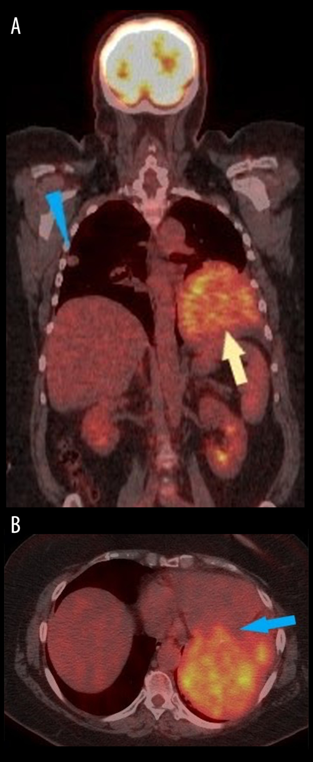 (A) Fused coronal PET/CT shows the large hypermetabolic left chest mass (light yellow arrow) as well as a contralateral metastatic pulmonary nodule (blue triangle). (B) Although the heart is typically hypermetabolic on PET, there is suspicion of invasion of the left basilar ventricle on axial fused PET/CT imaging (blue arrow).