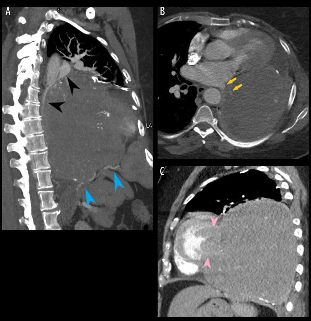 (A) Oblique MIP image of the chest from a CT angiogram shows branches of the left pulmonary artery (black arrowheads) extending into the mass. The lower aspect of the mass is a hypertrophied parasitic inferior phrenic artery (blue arrowheads). (B) Prominent veins within the mass drain into the left pulmonary vein (yellow arrows) on axial CT angiography. (C) Sagittal imaging demonstrates invasion of the left ventricle with hypervascular mass resulting in thickening of the basilar inferolateral wall (rose arrowheads).