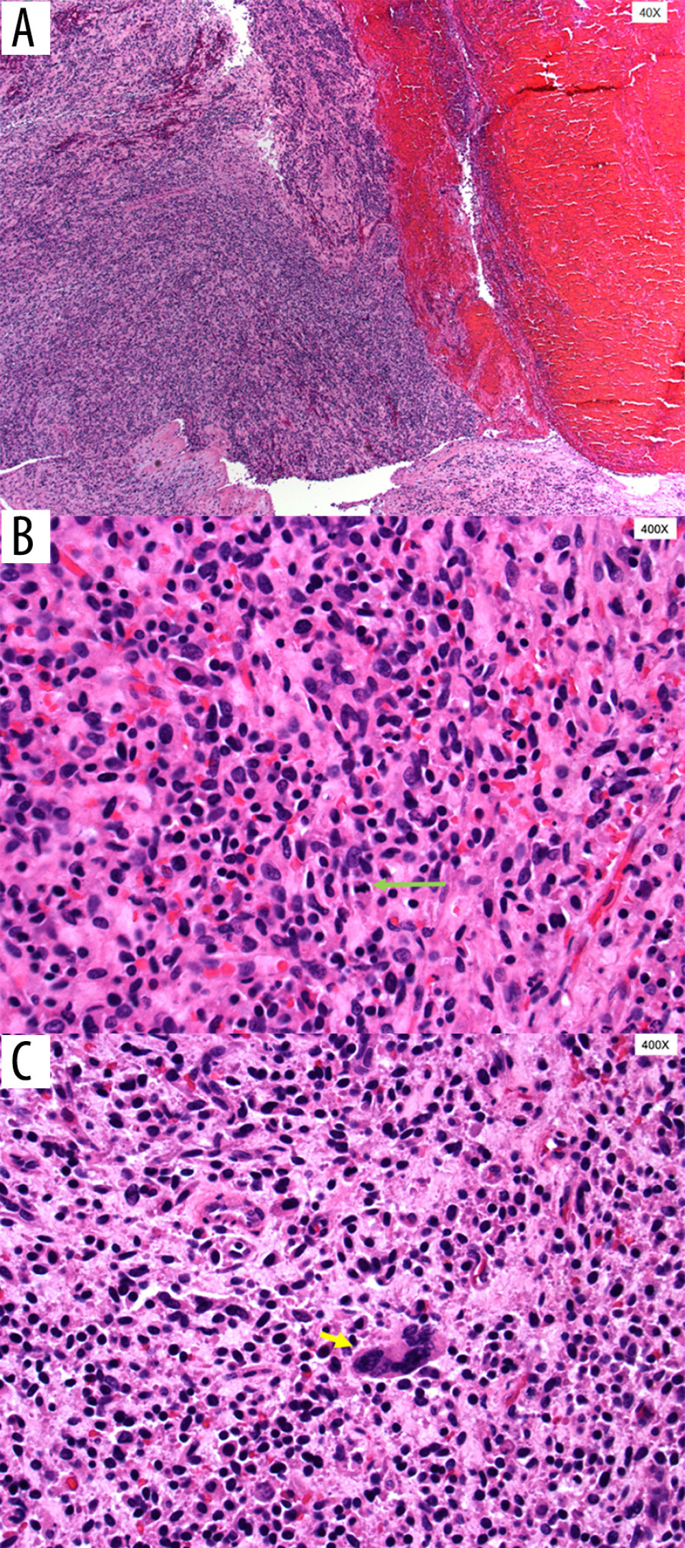 (A) Hypercellular tumor emboli associated with organizing fibrin and red blood cells. (B) Numerous mitotic figures (green arrow) are present in addition to scattered focal necrosis. (C) Malignant cells with scattered nuclear pleomorphism (yellow arrow) show a spindled epithelioid morphology.