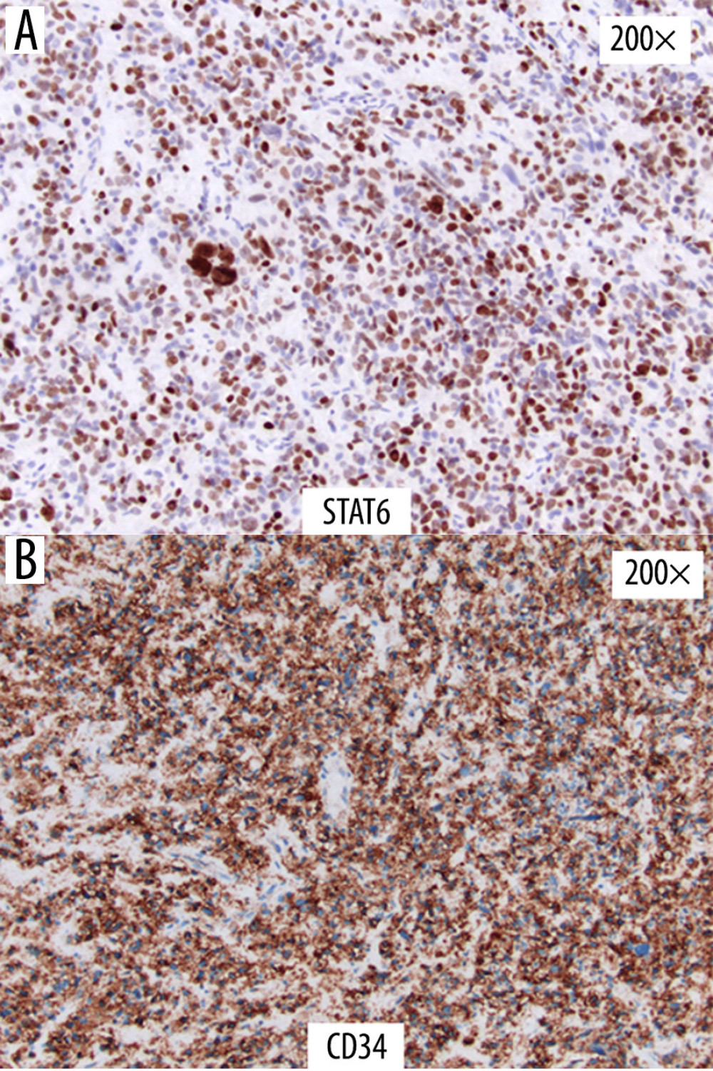 (A) Immunohistochemical stains including STAT6, which is highly sensitive and specific for solitary fibrous tumors, and (B) CD34 are positive in the tumor cells, supporting the diagnosis of SFT.
