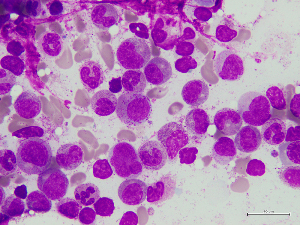 Bone marrow aspiration. Bone marrow aspiration specimen from the patient shows mild hypocellular marrow with erythroid hypoplasia, but platelet and myeloid precursor are entirely normal (100×).