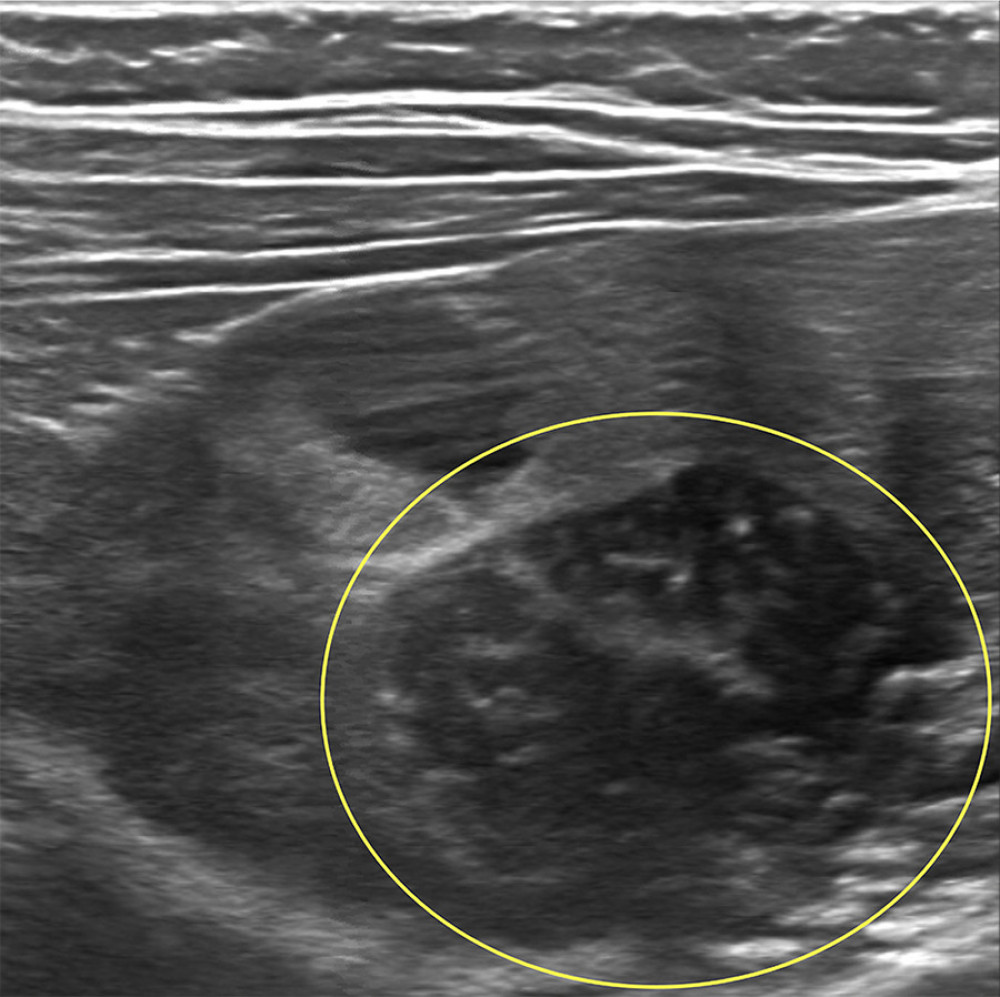 Ultrasound showing right lower quadrant mass (yellow circle) and inflammation.