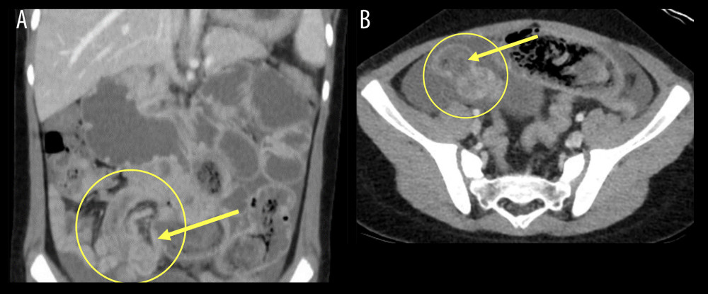 Computed tomography (CT) coronal (A) and axial (B) images demonstrating high-grade small-bowel obstruction: wall thickening and enhancement, with focus of ‘telescoping’, ‘swirling’ small bowel and mesenteric fat in the right lower quadrant suggestive of intussusception (yellow circle), moderate free fluid within the pelvis, and shadowing suggestive of an intraluminal bezoar (yellow arrow).