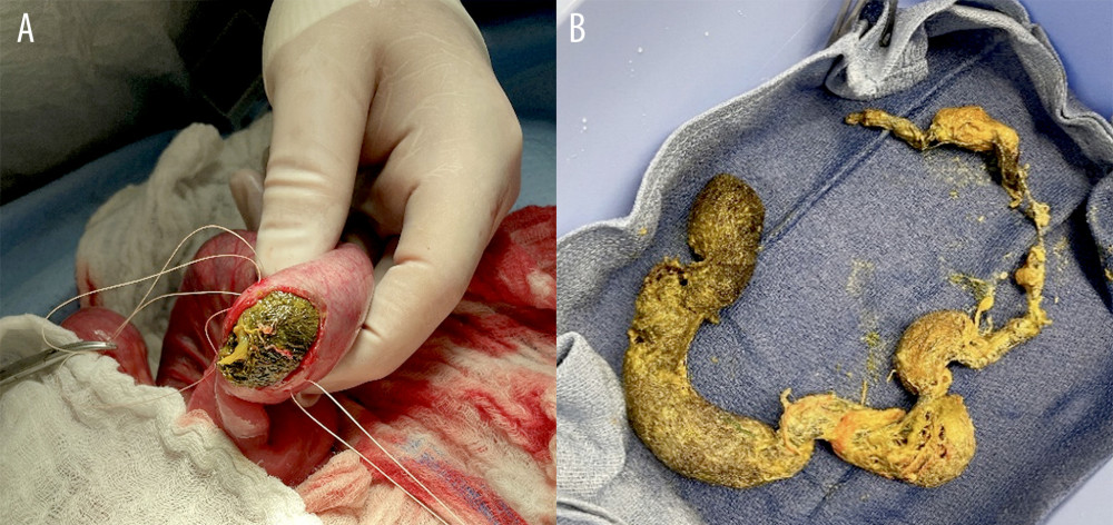 Evacuation (A) of trichobezoar after enterotomy and after removal of the trichobezoar (B).