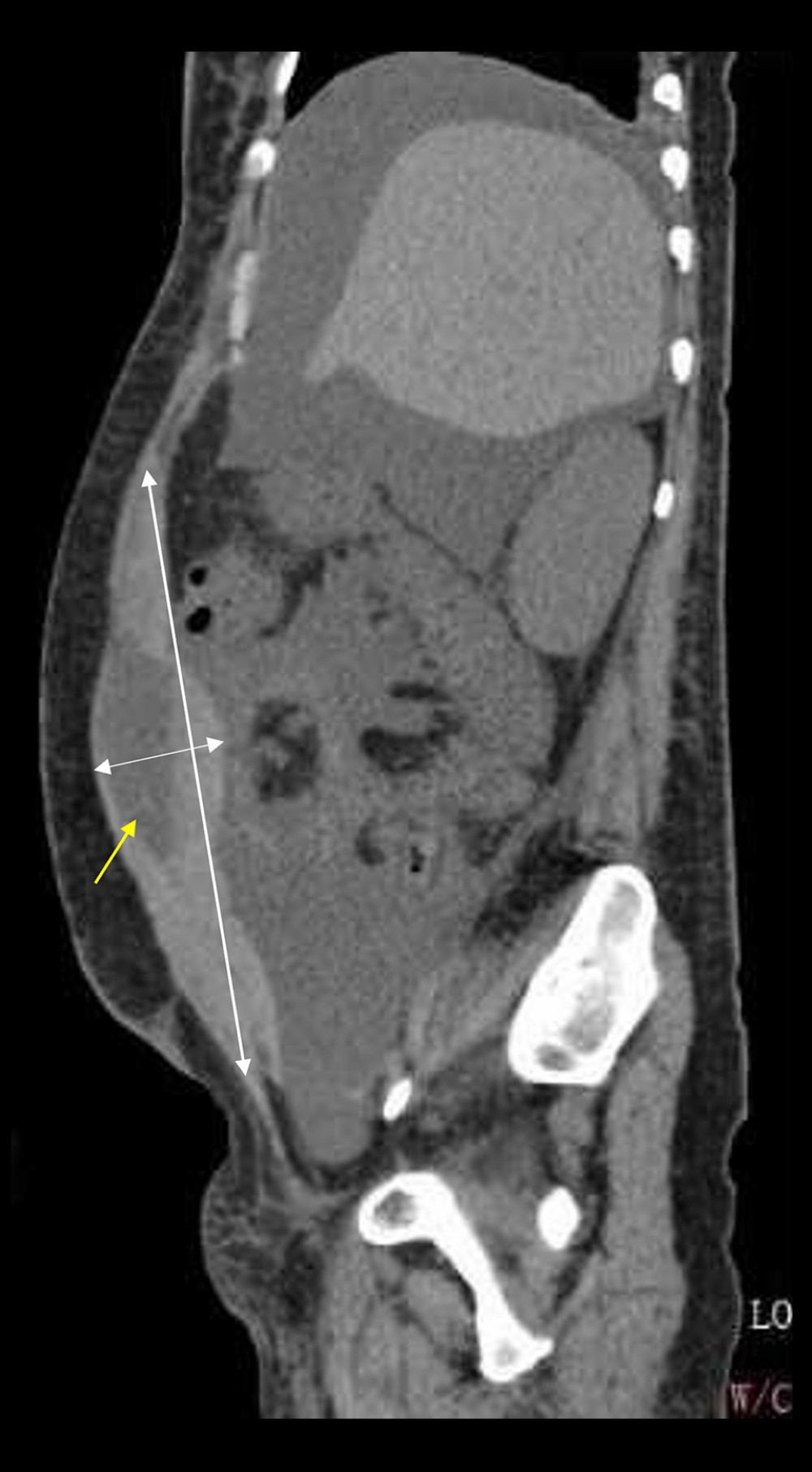Pretreatment computed tomography (CT) imaging in a 28-year-old woman with a flare of systematic lupus erythematosus and abdominal pain. CT scan showing RSH (yellow arrow) that measured 21.4×4.7 cm, massive ascites, and edema of the abdomen wall and intestinal wall (before treatment).