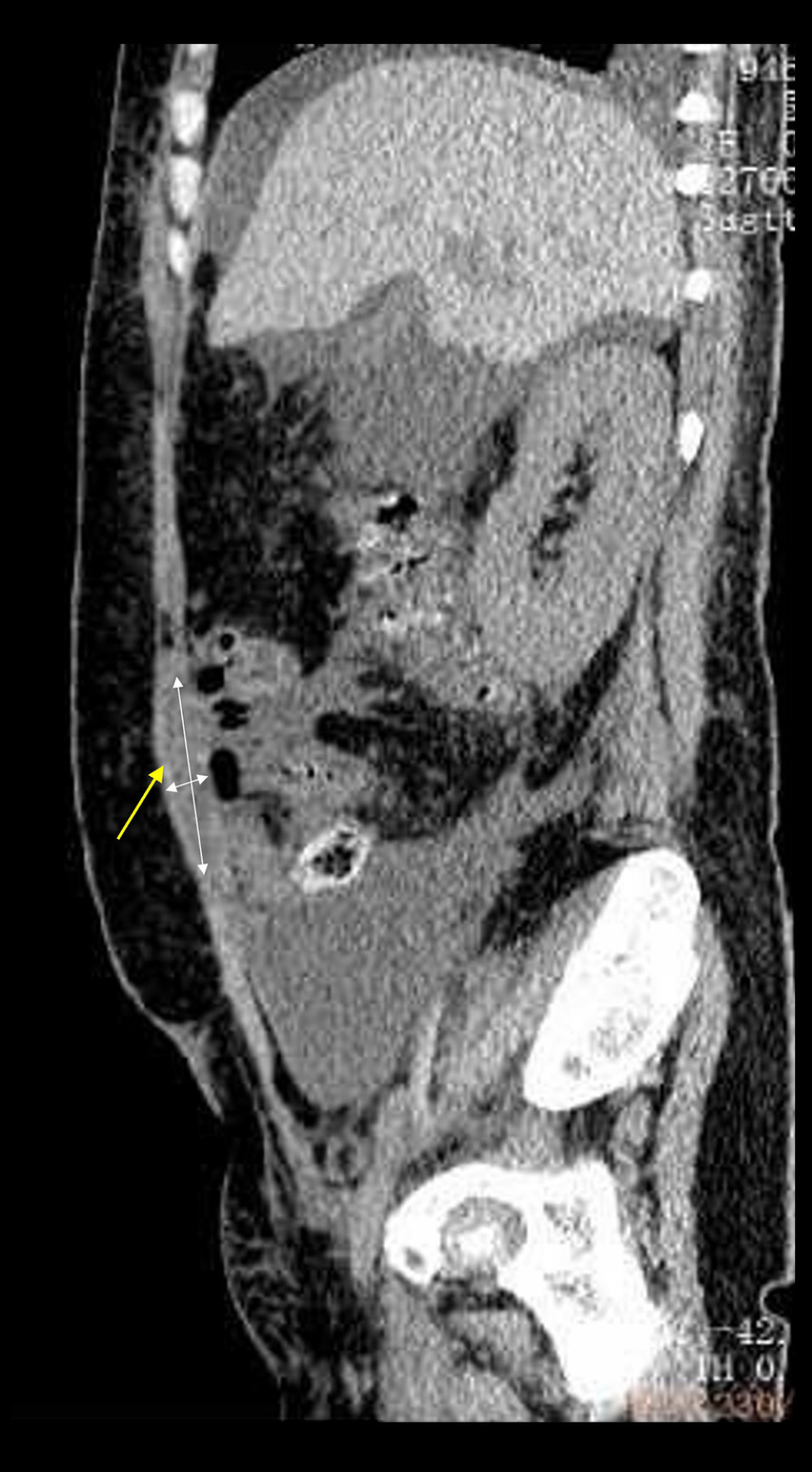 Posttreatment computed tomography (CT) imaging in a 28-year-old woman with a flare of systematic lupus erythematosus and abdominal pain. Posttreatment CT scan showed a reduction in the right RSH (yellow arrow) that measured 8.8×1.6 cm.
