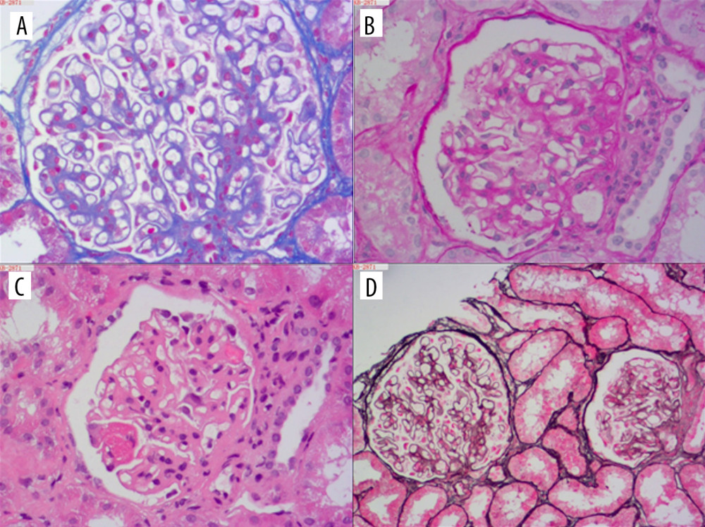 Photomicrograph of the histopathology analysis of the renal biopsy findings in a 28-year-old woman with a flare of systematic lupus erythematosus. (A) The renal glomeruli show mild to moderate segmental mesangial hypercellularity, increased mesangial cells, and thickening of the glomerular basement membrane. Periodic acid-Schiff. Magnification ×100. (B) Thickening of the glomerular basement membrane, segmental and mesangial capillary wall necrosis is present with mild tubular atrophy. Masson’s trichrome. Magnification ×60. (C) The renal interstitium shows fibrosis and infiltration with mononuclear cells. Hematoxylin and eosin. Magnification ×60. (D) Silver staining shows thickening of the tubular and glomerular basement membrane. Methenamine-silver. Magnification ×40. These histological features are consistent with SLE membranoproliferative glomerulonephritis, Class III and Class V.