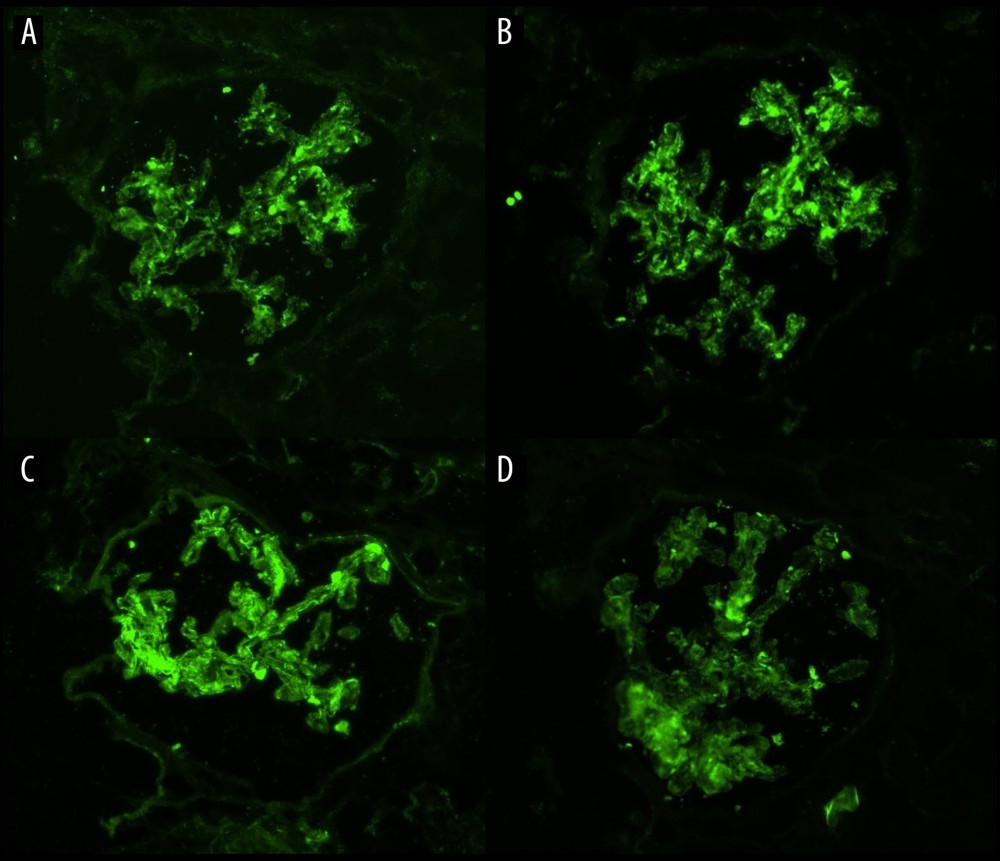 Immunofluorescence shows full house positivity for immunoglobulin (IgG, IgA) and complements (C3, C1q). (A) C1q granular deposits in the mesangial region and capillary loops. (B) C3 diffuse and granular deposits in the mesangial area, and segmental positivity along with the capillary loops. (C) IgG granular and segmental deposits in the mesangial region and capillary loops. (D) IgA granular deposits in the mesangial region.