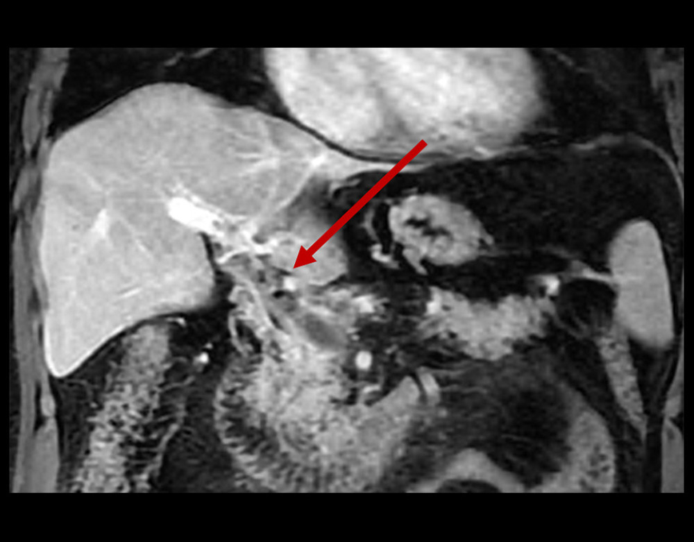 Magnetic resonance angiogram of the abdomen performed on hospital admission, leading to the diagnosis of portal and mesenteric vein thrombosis. The arrow is pointing to a portal venous thrombus with gas.