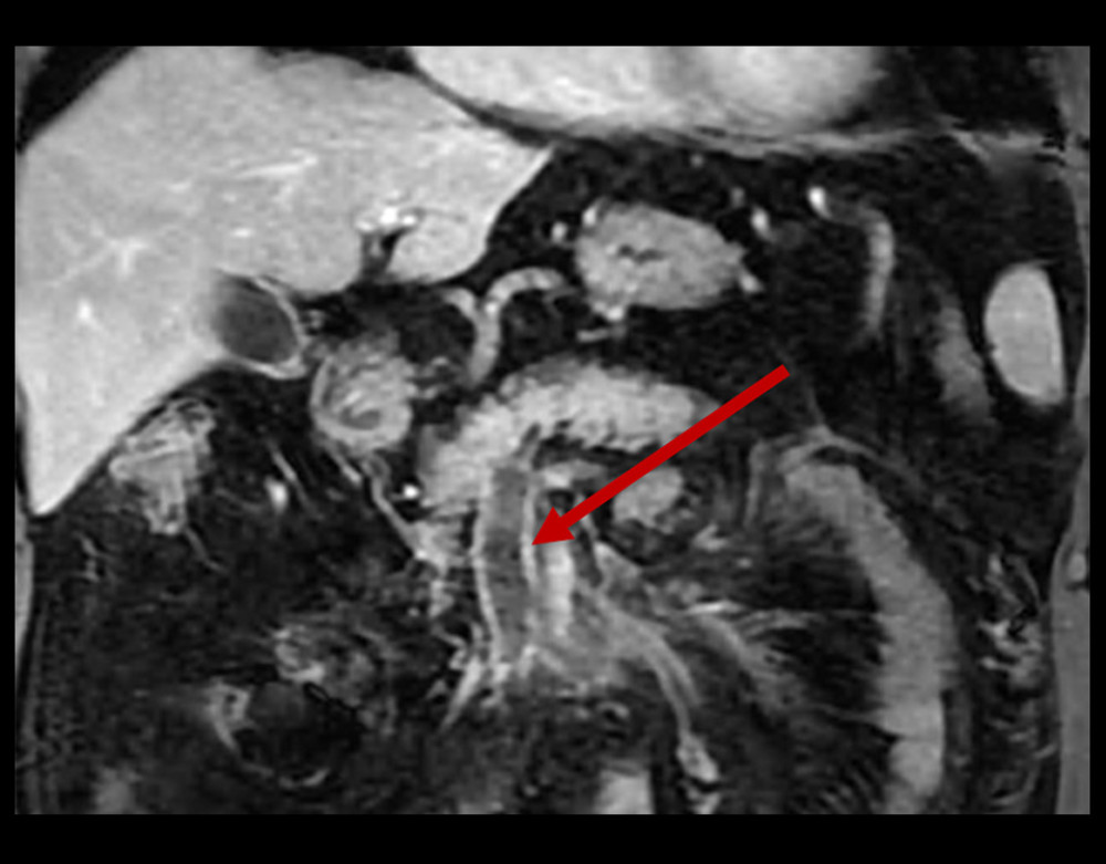 Magnetic resonance angiogram of the abdomen performed on hospital admission, leading to the diagnosis of portal and mesenteric vein thrombosis. The arrow is pointing to the superior mesenteric vein thrombus with gas.