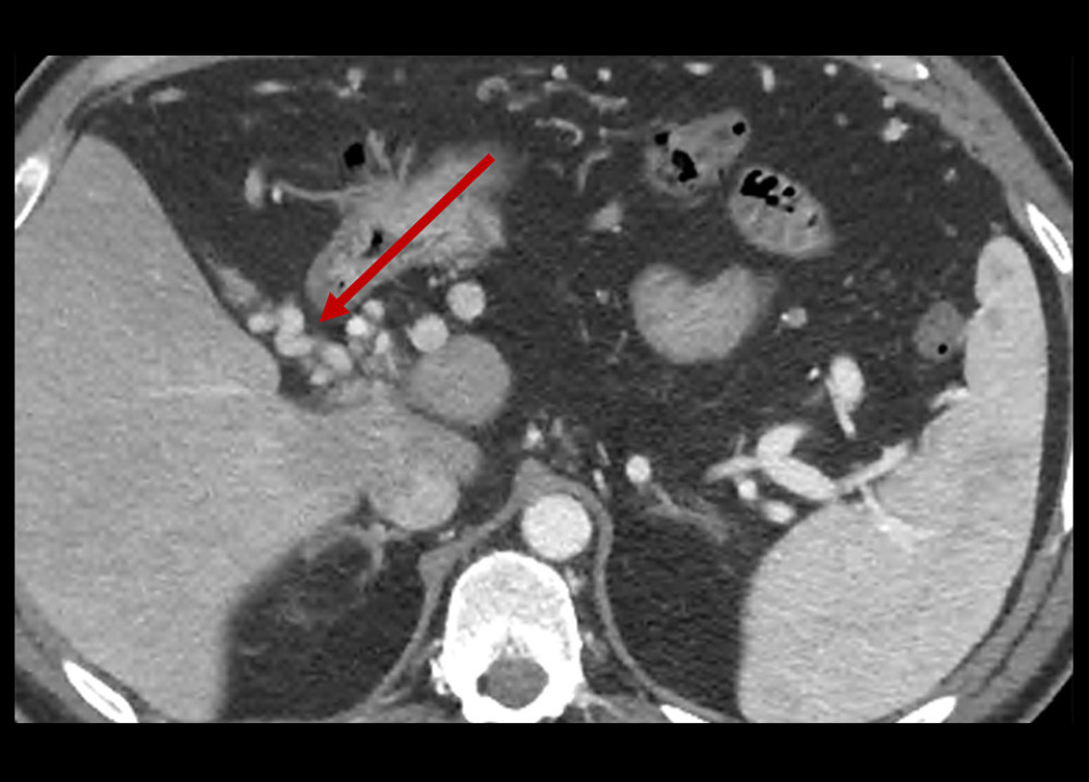 Computed tomography scan of the abdomen with intravenous contrast 2 months after initial presentation showing chronic thrombus with collateral venous circulation. The arrow is pointing to a portal venous collateral vessel that formed secondary to chronic portal venous thrombus.