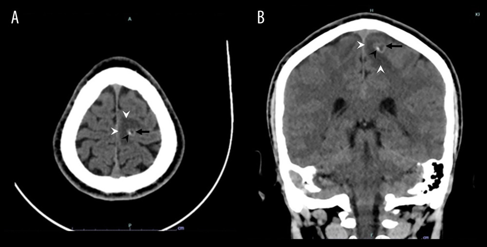 Axial (A) and coronal (B) pre-contrast computed tomography (CT) of the brain revealed a 1-cm well-defined cystic lesion with wall hyperdensity (black arrow), tiny intralesional eccentric calcification (black arrowhead), and perilesional edema (white arrowhead) at the left superior frontal gyrus.