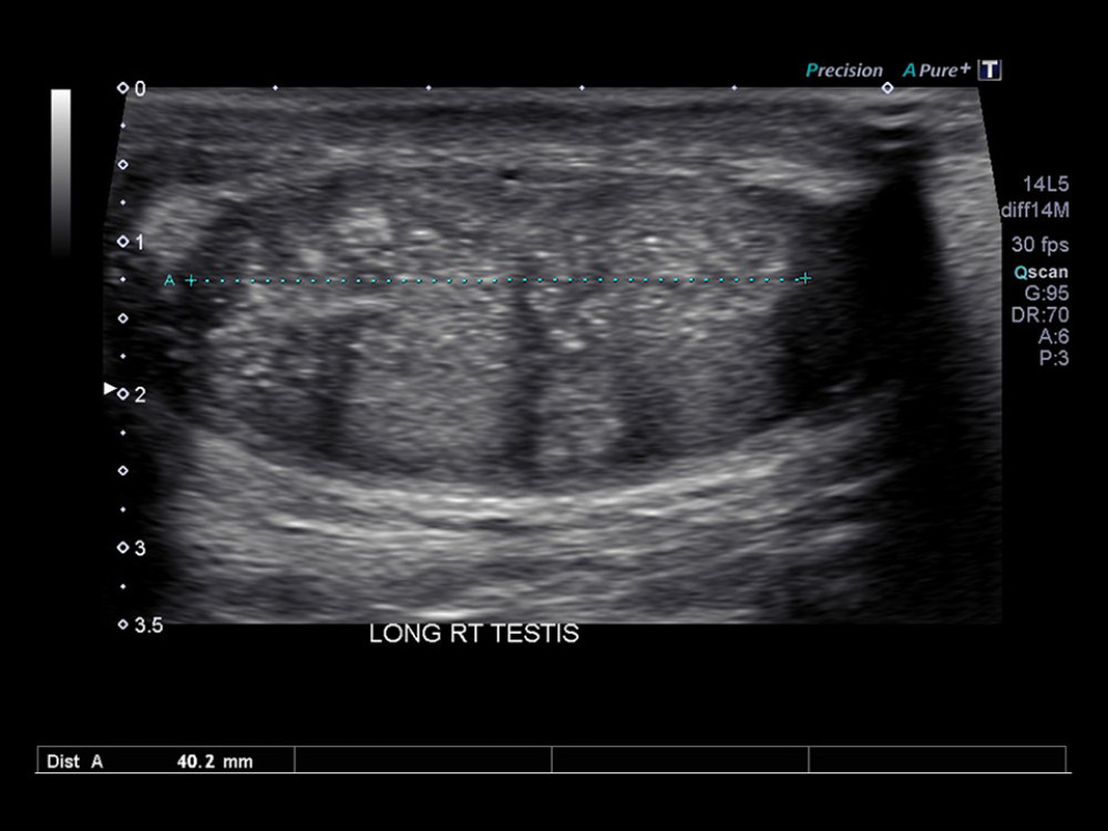 Right testicular ultrasound showing a 4.0 cm section of the 5.5×3.5×2.5 cm heterogeneous mass with internal calcifications.
