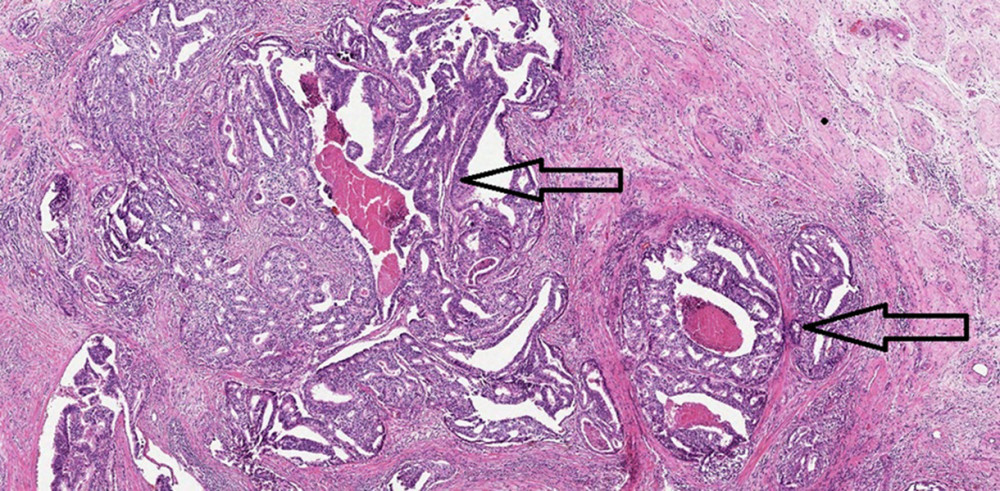Low-power magnification shows extensive large gland cribriforming architecture with focal areas of comedo necrosis. Arrows display areas of necrosis within the cancer tissue.