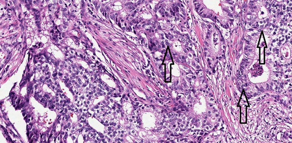High-power imaging shows glandular architecture with prominent nucleoli consistent with prostate cancer, as indicated by the arrows.