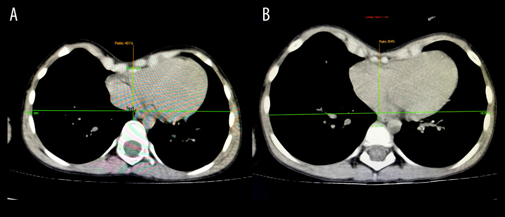 Chest computed tomography scan showing pectus excavatum deformity in (A) the female patient and (B) the male patient before surgical correction.