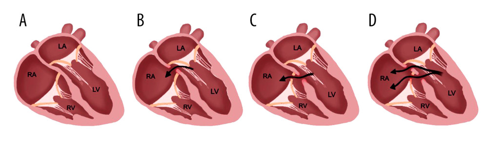 Three types of Gerbode defect. Normal interventricular septum (A). Direct Gerbode defect (B). Indirect Gerbode defect (C). Intermediate Gerbode defect (D). Illustration by Soetisna TW (2021).