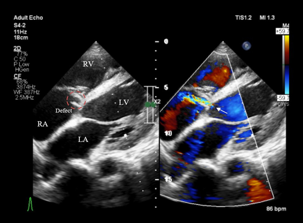 Transthoracic echocardiography. Transthoracic echocardiography revealed 0.5-mm gap (white arrow) at the atrioventricular septum connecting left ventricle with right atrium with left-to-right shunt. RV – right ventricle; RA – right a; LV – left ventricle; LA – left atrium.