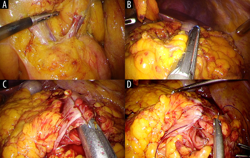 Intraoperative findings 2. (A) Exposure of each blood vessel during operation. (B) Intracorporeal transection of the distal transverse colon. (C) Side-to-side anastomosis in an overlap fashion. (D) Closure of the common-entry incision.