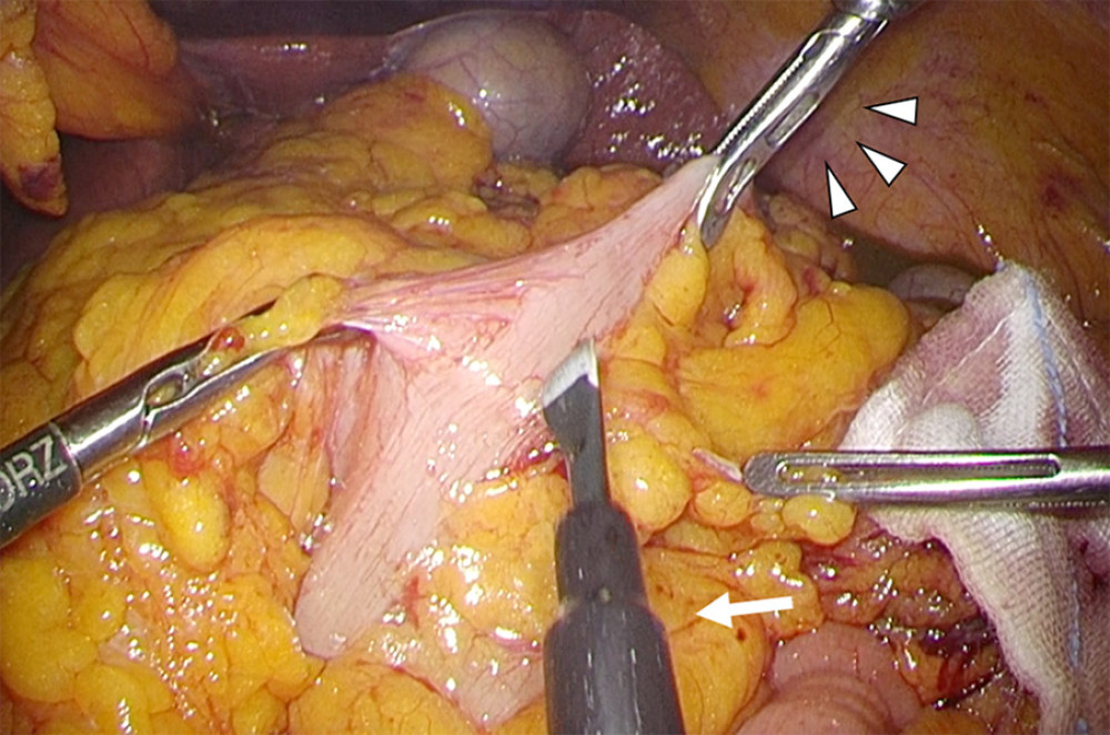 Operative appearance was similar to preoperative image training. White arrow shows the surgeon’s right hand, and white arrow heads show the first assistant’s right hand.