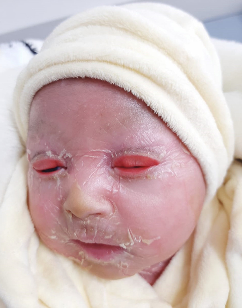 mild lamellar ichthyosis