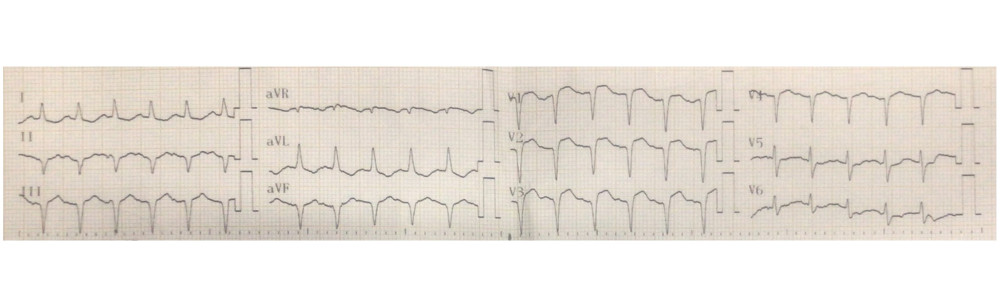 Electrocardiogram recorded at admission. Sinus rhythm of 150 bpm, QS wave in V1 and V2 and inferior leads, ST elevated segment in V1, V2, and V3 leads.