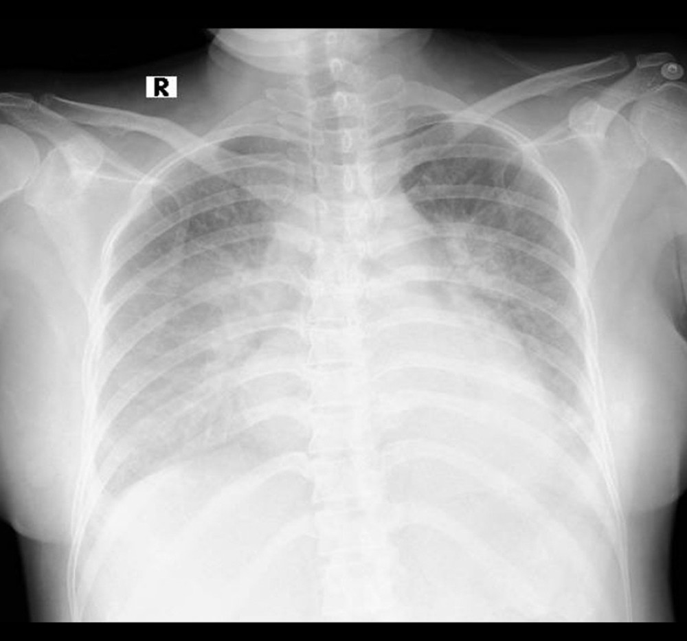Plain chest radiograph at admission. Peribronchial cuffing and an elevated cardiothoracic ratio.
