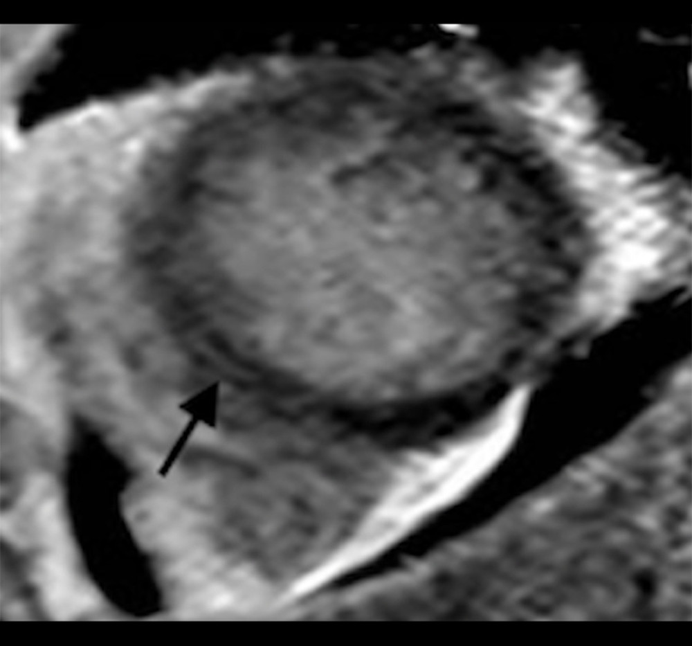 T2-TIRM (Turbo inversion recovery magnitude) sequence in short-axis view shows a high signal intensity in the posterolateral wall of the left ventricle (arrow), which suggests myocardial edema.