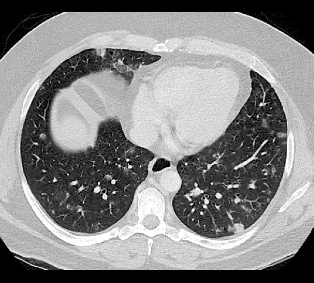 Chest CT demonstrates multiple bilateral pulmonary nodules of various sizes and densities, some ground-glass and some solid, with a basilar predominance, most consistent with septic emboli.