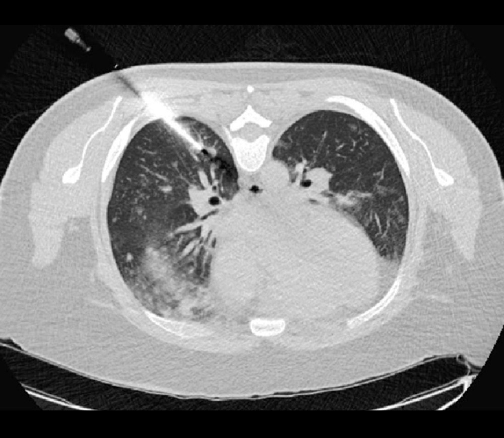 CT image obtained during lung biopsy showing the introducer needle in place abutting a right lower lobe pulmonary nodule.