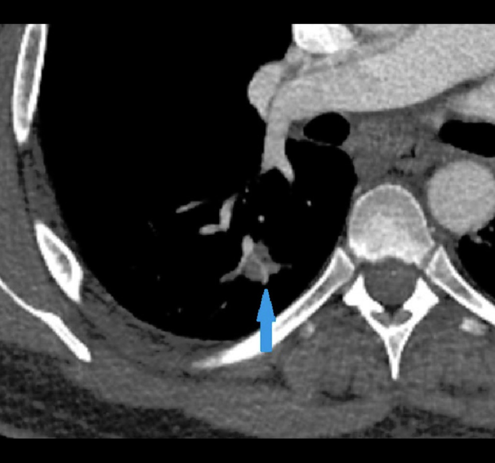 Contrast-enhanced CT of the chest performed at the time of stroke shows “traversing vessel sign” commonly seen with septic emboli. Notably, the blue arrowhead shows a vessel leading to the right inferior pulmonary vein.